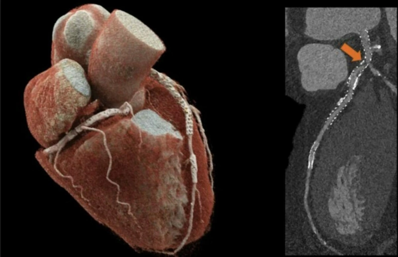 Normal Ctca Practice Points for CTCA | News | Allevia Cardiology Ascot